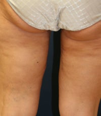 Thighplasty