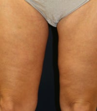 Thighplasty