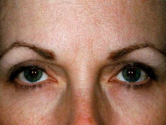 Botox