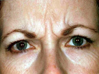 Botox