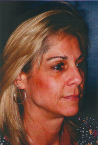 Laser Skin Resurfacing