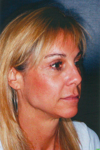 Laser Skin Resurfacing