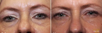 Laser Resurfacing