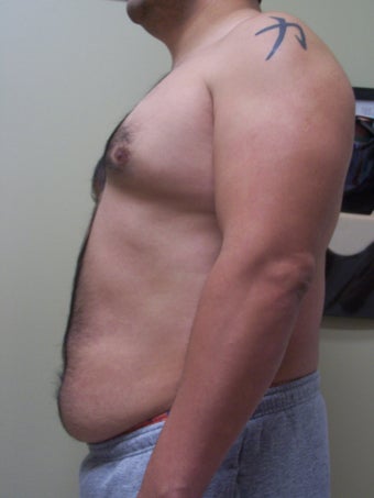 Vaser Liposuction