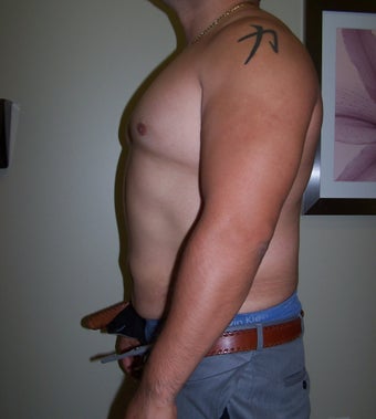 Vaser Liposuction