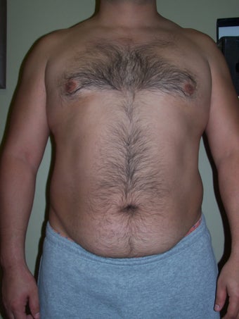 Vaser Liposuction