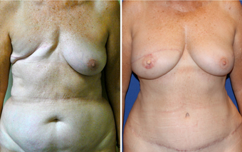 DIEP - Breast Reconstruction