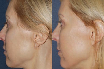 Before & After Fraxel