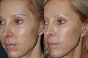Before & After Fraxel