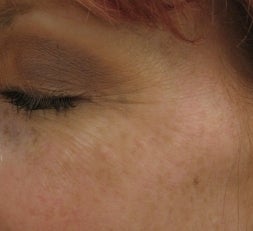 Crows feet after a single 1540 Lux Fractional Laser Treatment