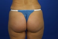 51 Year Old Patient Treated for Buttock Drooping & Flatness