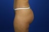 51 Year Old Patient Treated for Buttock Drooping & Flatness