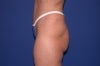 51 Year Old Patient Treated for Buttock Drooping & Flatness