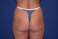 51 Year Old Patient Treated for Buttock Drooping & Flatness