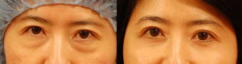 Lower eyelid surgery