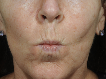 Dermal Fillers