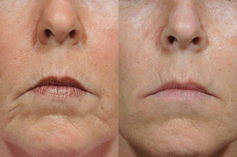 Dermal Fillers