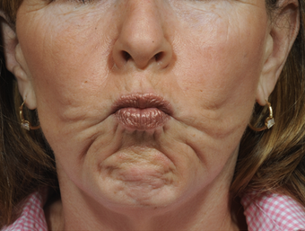 Dermal Fillers