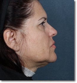 Face & Neck Lift