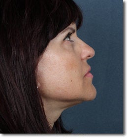 Face & Neck Lift