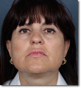 Face & Neck Lift