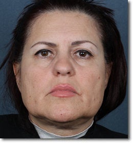 Face & Neck Lift