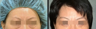Lower Eyelid(Blepharoplasty) Surgery