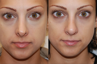 Non-Surgical Nose Job