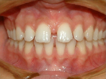Invisalign
