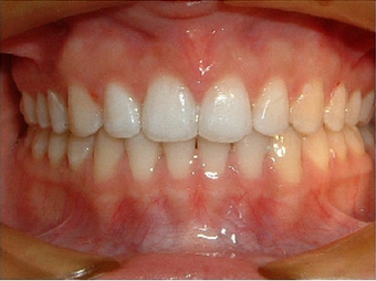 Invisalign