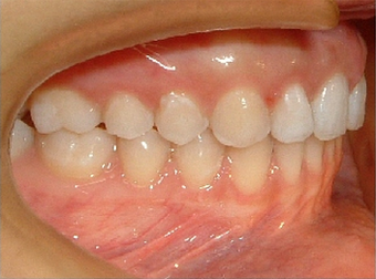 Invisalign