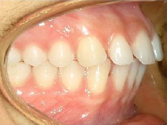 Invisalign