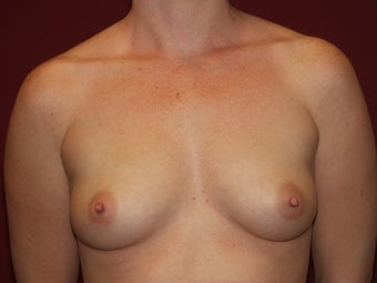Breast Implants