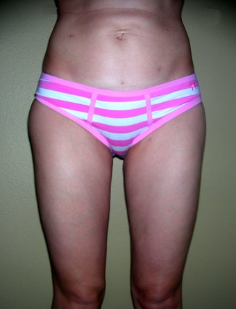 Vaser liposuction