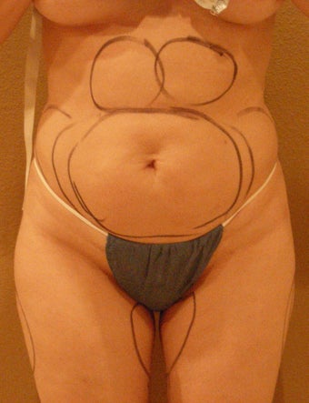 Vaser liposuction