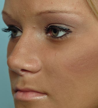 18 Year-Old Female Treated For Midface Deficiency