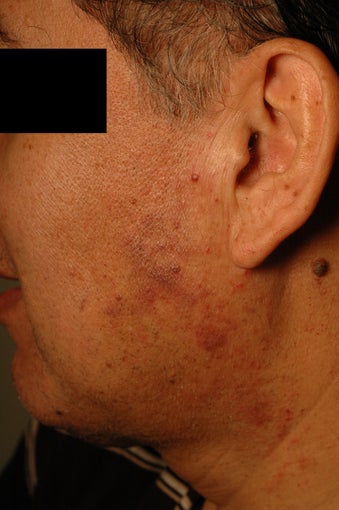 Birthmark Removal Before and After Photos