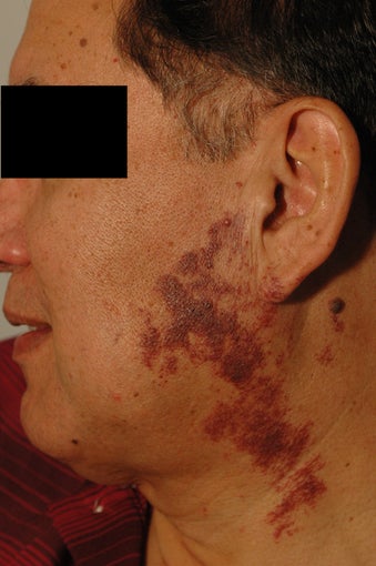 Birthmark Removal Before and After Photos