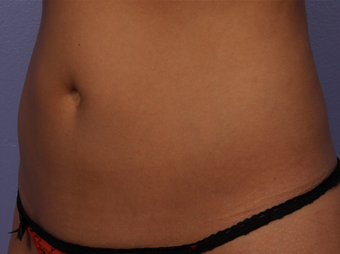 CoolSculpting by Zeltiq to Abdomen