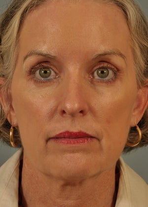 Phenol Peel