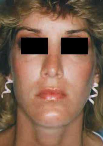 Revision Rhinoplasty