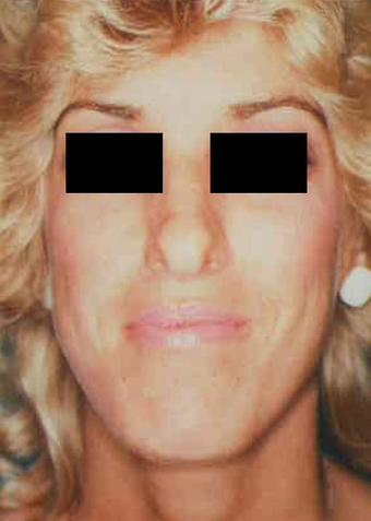 Revision Rhinoplasty