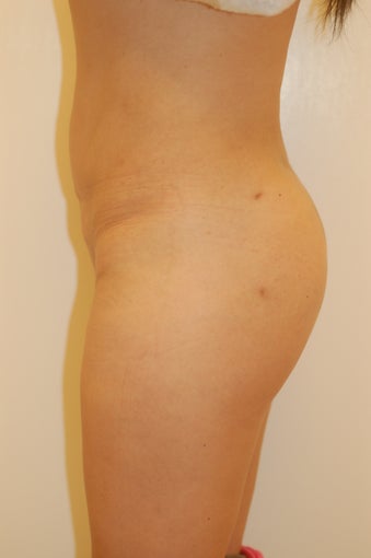 Buttock Enhancement