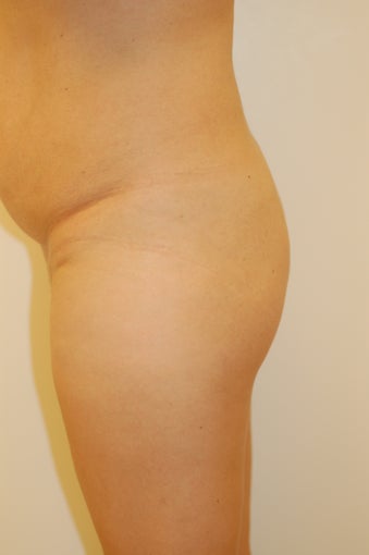 Buttock Enhancement