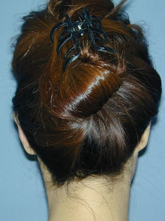 Otoplasty/Ear Surgery
