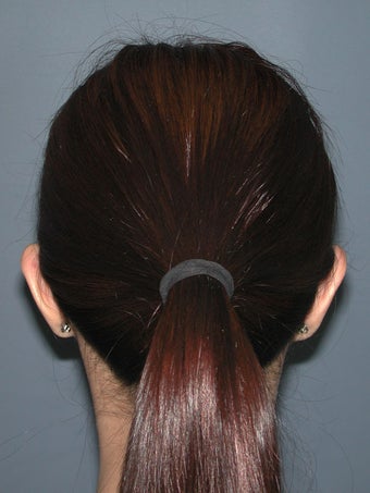Otoplasty/Ear Surgery