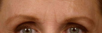 Botox