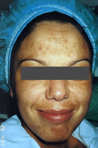 Hispanic woman 30-40 year old treated for Melasma and Acne Scars
