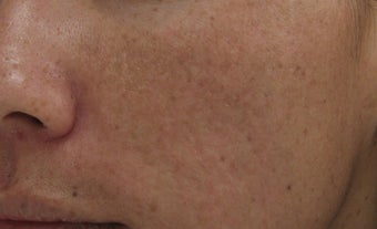 Fraxel repair CO2 laser resurfacing for acne scars