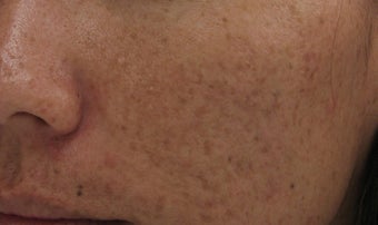 Fraxel repair CO2 laser resurfacing for acne scars